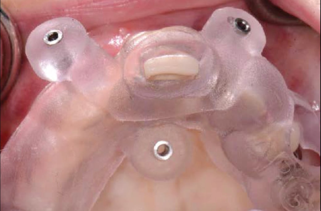 A Digital Approach to Immediate Placement with Implant Concierge