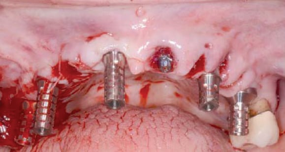 Guided Dental Implant Surgery Tissue Graft Temporary Cylinders